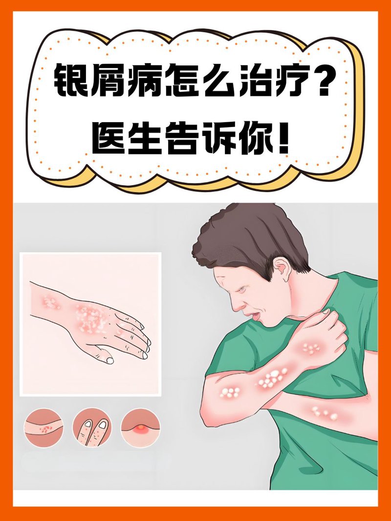 湿疹医院:如何找到最适合自己的治疗方法