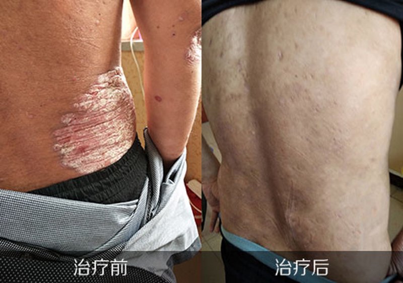 银屑病治疗:最新进展与未来方向